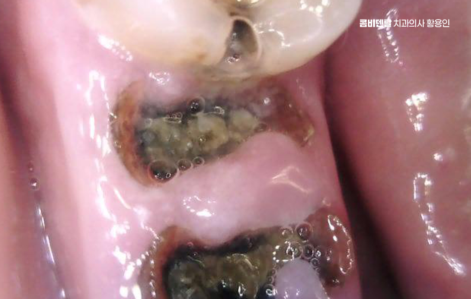 Be Careful Not to Delay Treatment for Cavities Between Your Teeth image 5