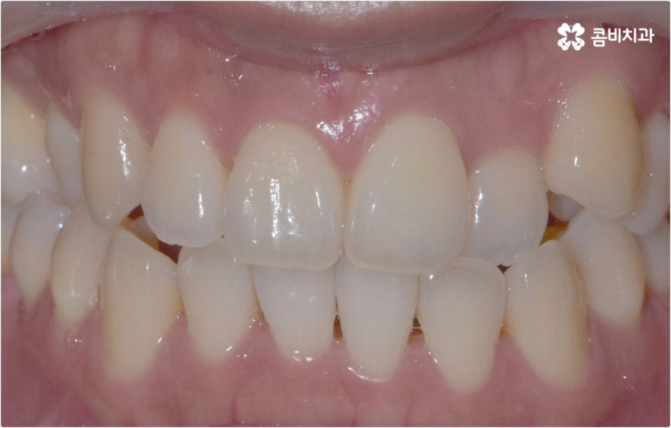 치아설측교정 보이지않아 좋아요 관련 이미지 5