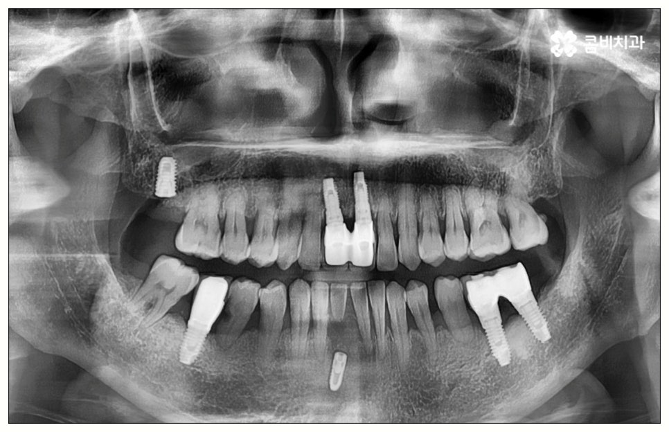원데이임플란트 어떤가요? 관련 이미지 4