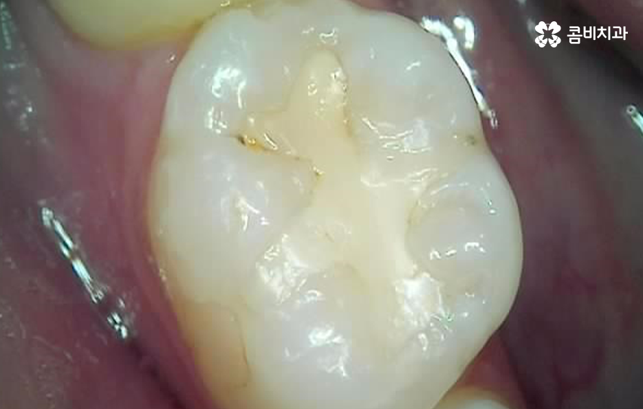 레진 인레이 치료 후 2차충치 왜 발생하고 어떻게 대처할까 관련 이미지 6