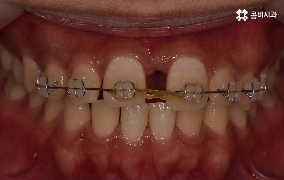 앞니만 교정 과잉치 뽑아서 해결했어요 관련 이미지 8