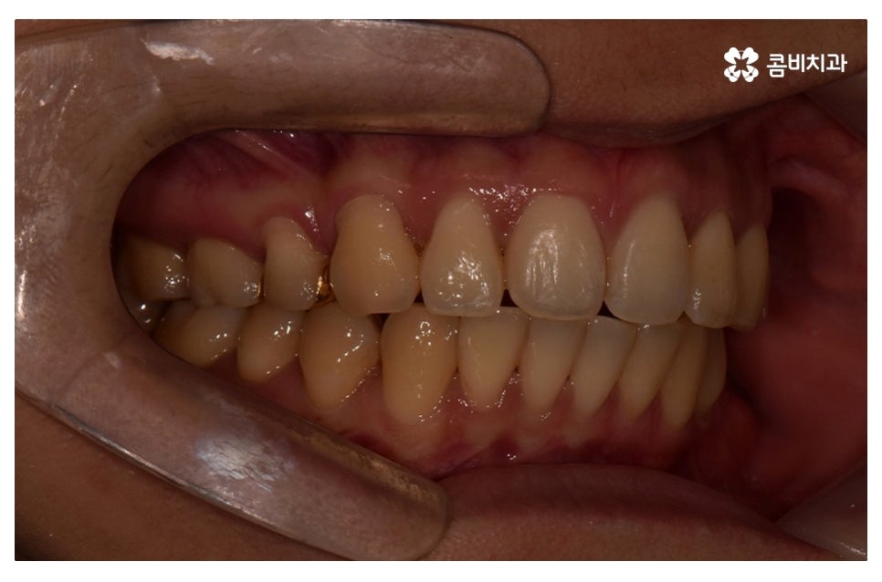 덧니교정 정확하게 알아보려면 관련 이미지 15