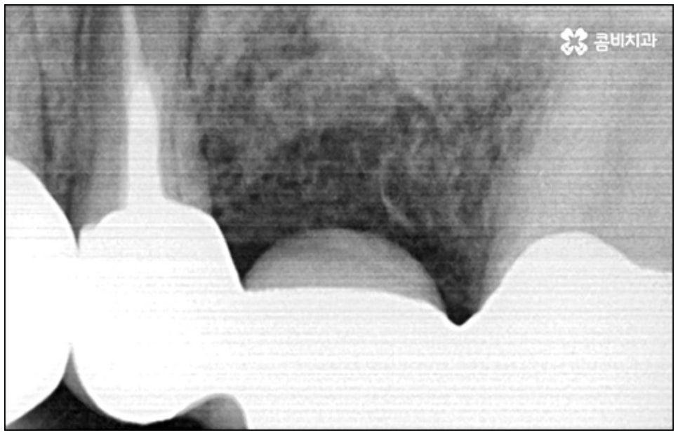 당일임플란트 나도 할수있나요 관련 이미지 12