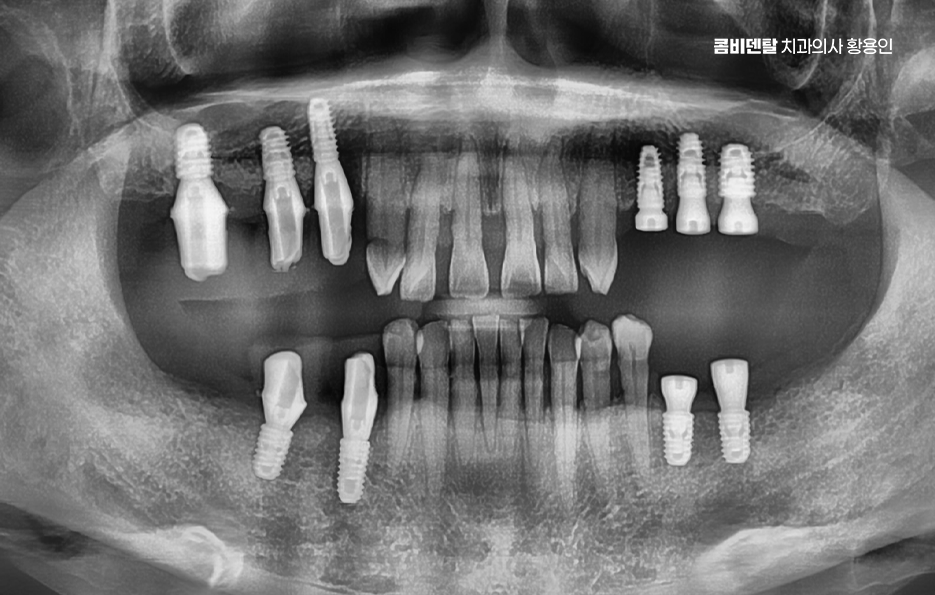 어금니 발치후 임플란트 안하면 어떻게 변하는걸까 관련 이미지 12