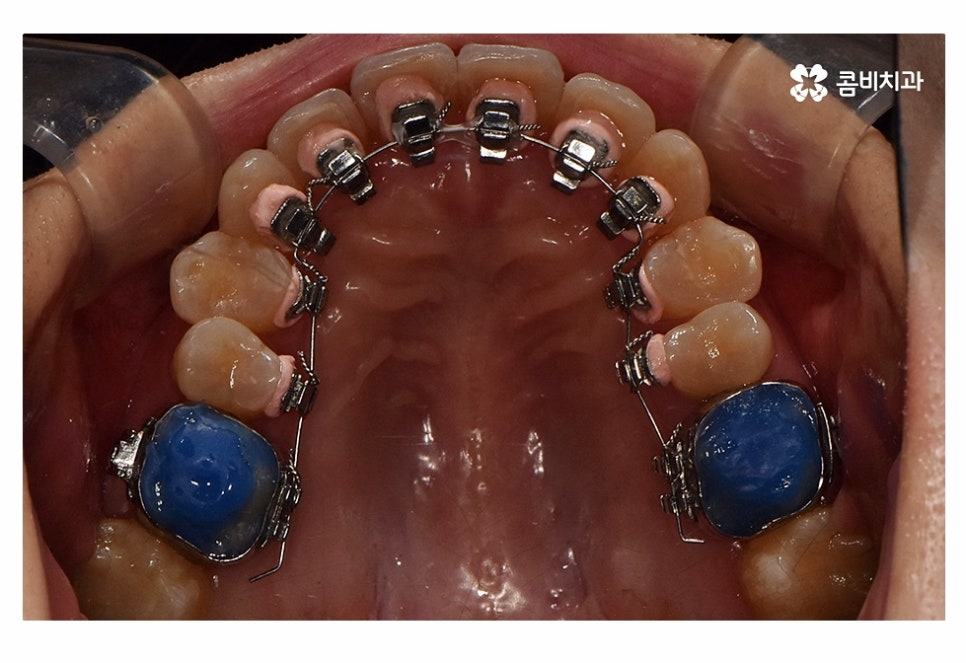 치아설측교정 가능한지 궁금하다면 관련 이미지 8