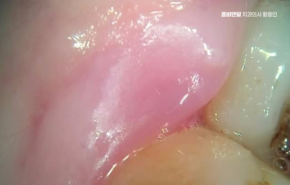 사랑니 주변 잇몸 통증 지금부터가 중요하니까 관련 이미지 4