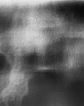 어금니 뒤 잇몸 부음 어떤 문제길래 이런거죠 관련 이미지 12