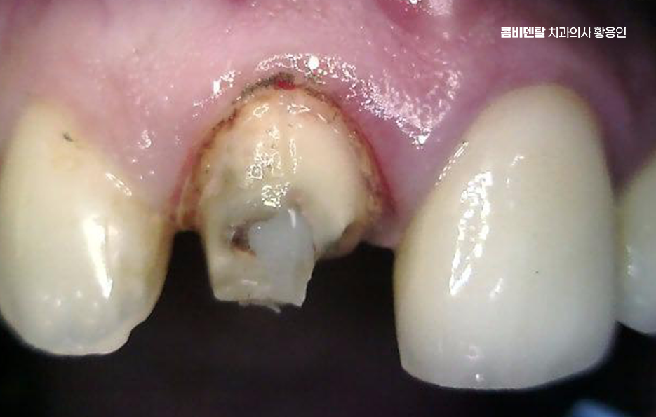 앞니 신경치료 크라운 까지 해야할 상황이라면 관련 이미지 6