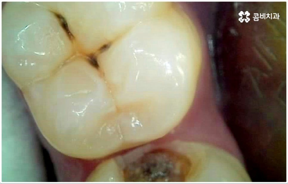 치아사이충치 놔두면 안돼요 관련 이미지 10