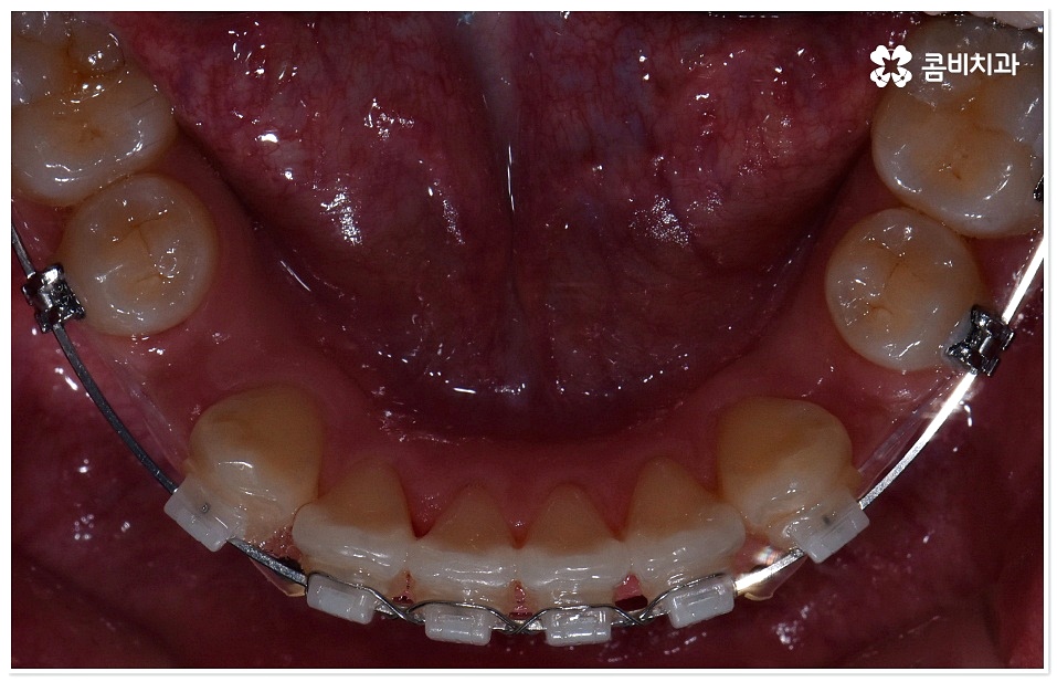 덧니치아교정 고려할 사항들은 관련 이미지 8