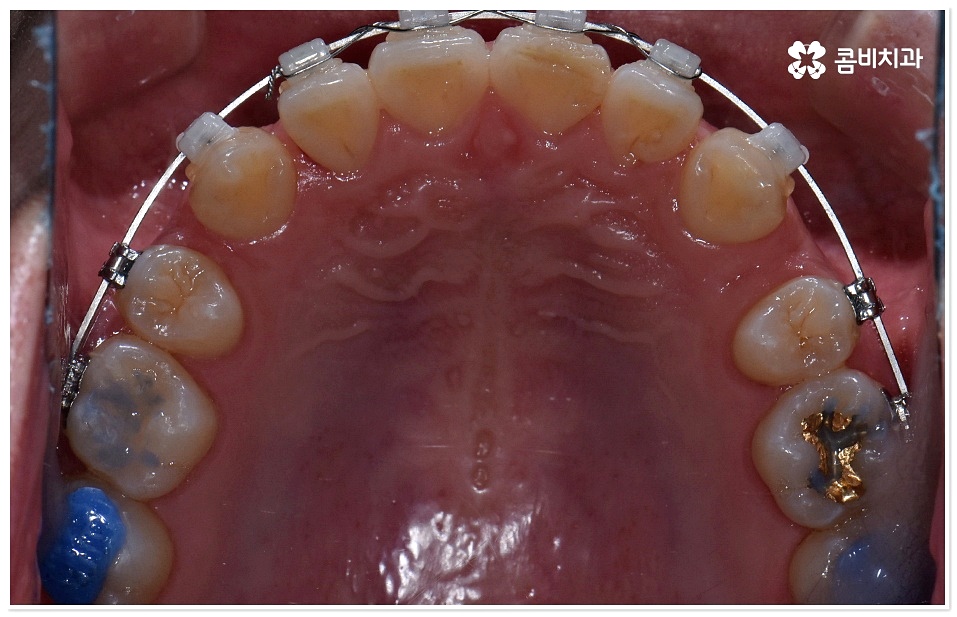 덧니치아교정 고려할 사항들은 관련 이미지 7