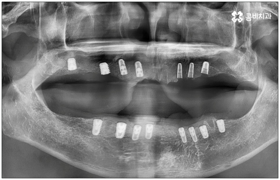 노인임플란트 참고사항 알아봐요 관련 이미지 10
