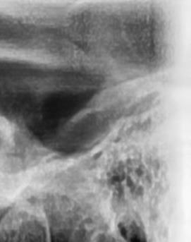 어금니 뒤 잇몸 부음 어떤 문제길래 이런거죠 관련 이미지 17