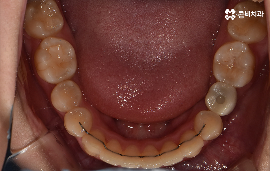 덧니 발치 교정 이런 경우에는 필요합니다 관련 이미지 16
