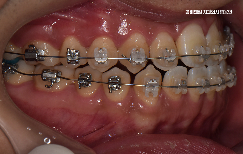 클리피씨교정 장단점 어떻게 비교하면 될까요 관련 이미지 5