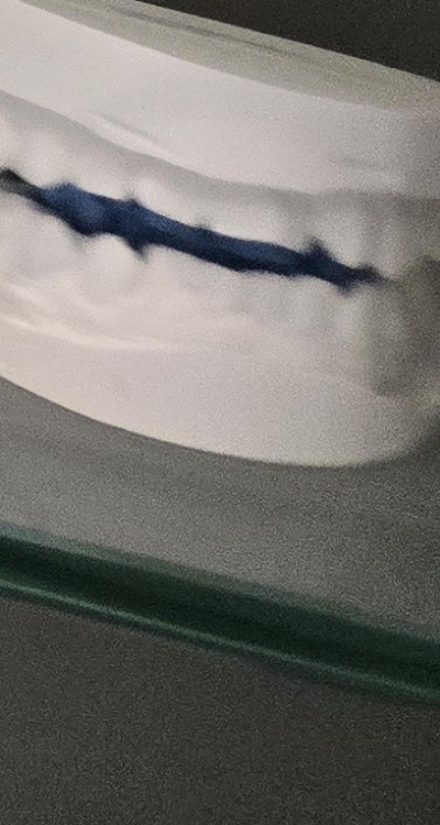 윗니 전체 임플란트 뭐부터 해야할까 관련 이미지 49