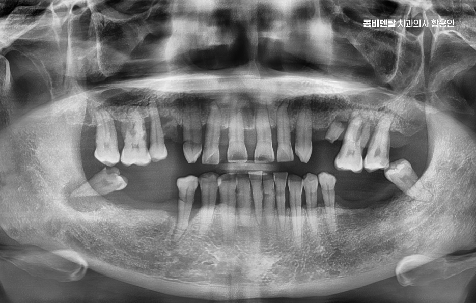 어금니 발치후 임플란트 안하면 어떻게 변하는걸까 관련 이미지 1