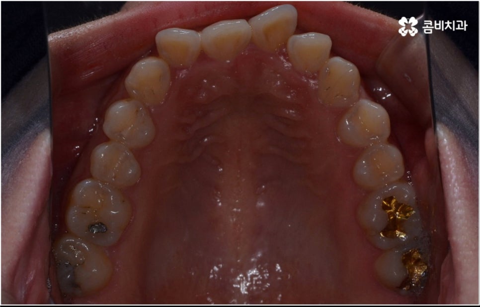 성인 치아교정 기간 걱정이 앞서나요 관련 이미지 5