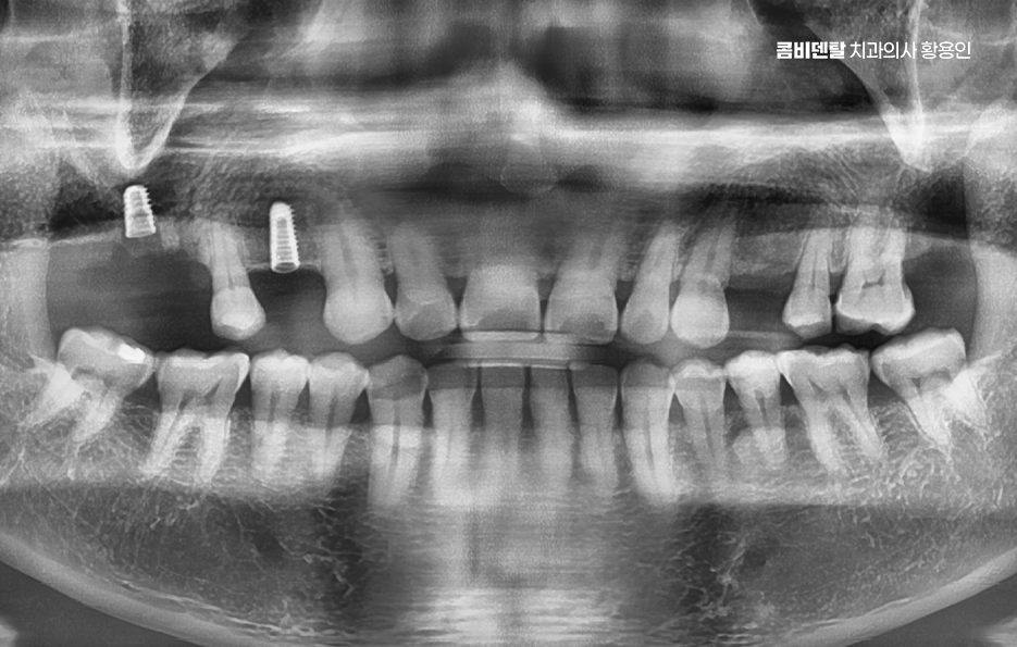 어금니 없으면 얼굴 발음에 어느정도나 안좋을까 관련 이미지 7