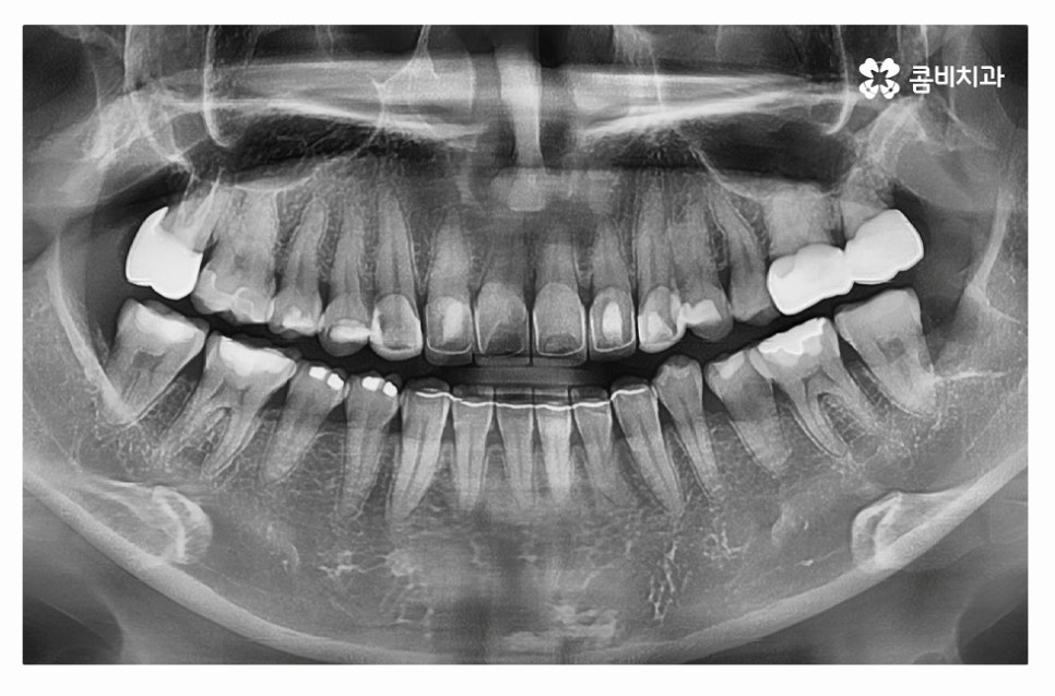 누운사랑니발치 언제 뽑을지 고민이라면 관련 이미지 9