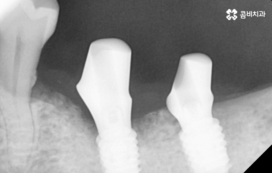 건강보험 임플란트 적용 받기 전에 알아두세요 관련 이미지 6