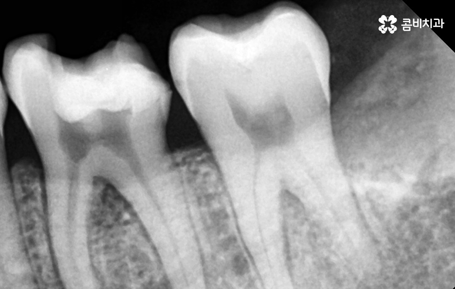 사랑니 어금니 통증 동시에 아프다면 관련 이미지 6