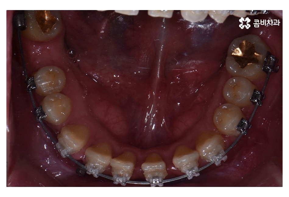 클리피씨교정 늦지않게 결정하려면 관련 이미지 13