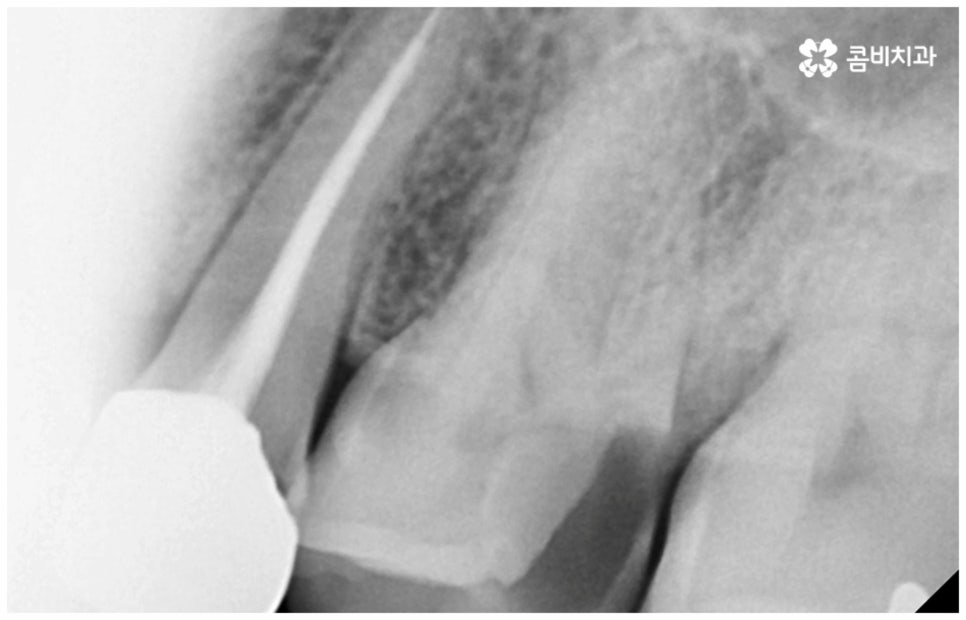 어금니신경치료 케이스마다 달라요 관련 이미지 9