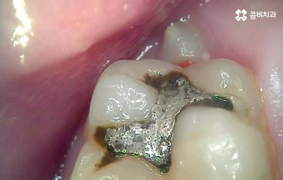 어금니 충치치료 깔끔하게 해결하려면 관련 이미지 2