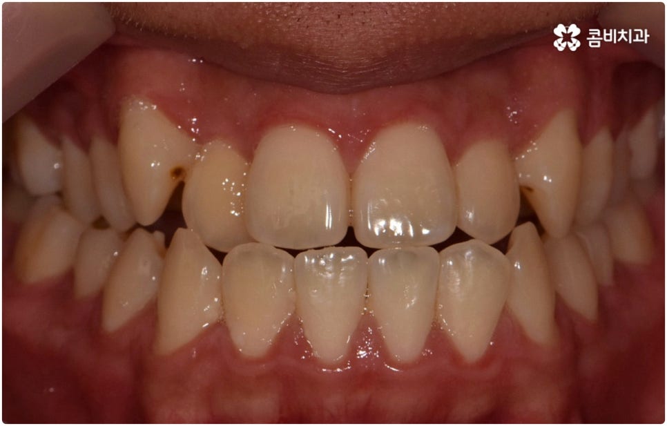 부정교합 3급 고치는 방법은 관련 이미지 3