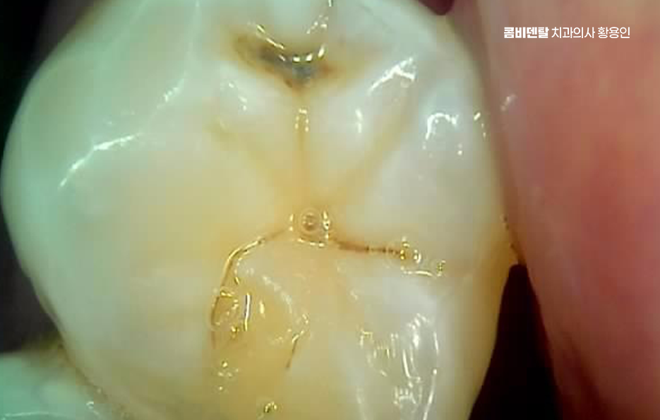 충치 검은점 나타났다면 이렇게 대처해요 관련 이미지 1