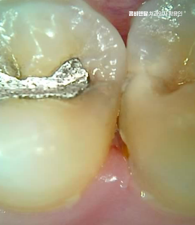 아말감 교체 레진 인레이 어떻게 대처하면 될까 관련 이미지 1