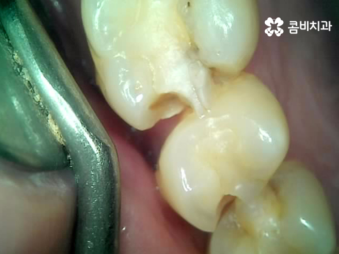 치아 깨짐 다시 튼튼하게 수복하기 위한 방법 관련 이미지 3