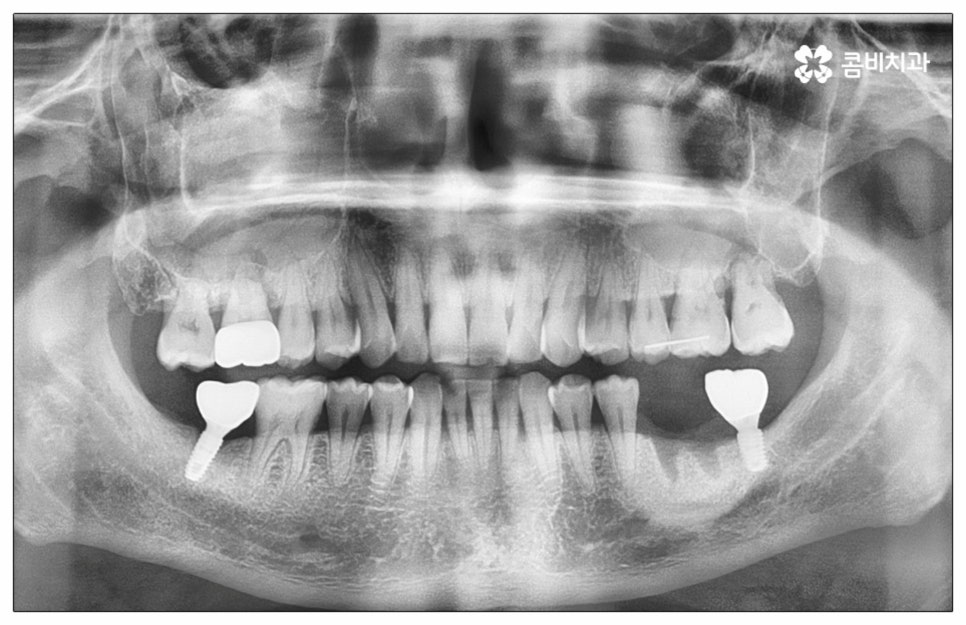 건강보험임플란트 혜택받아 보세요 관련 이미지 4