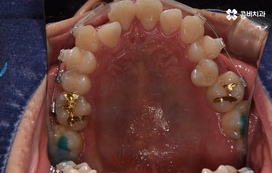 30대 치아교정 빨리 끝내고 싶어요 관련 이미지 9