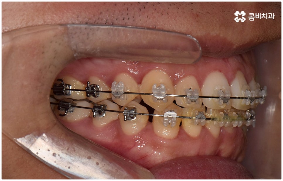 부정교합 3급 왜 고쳐야 하나요 관련 이미지 11