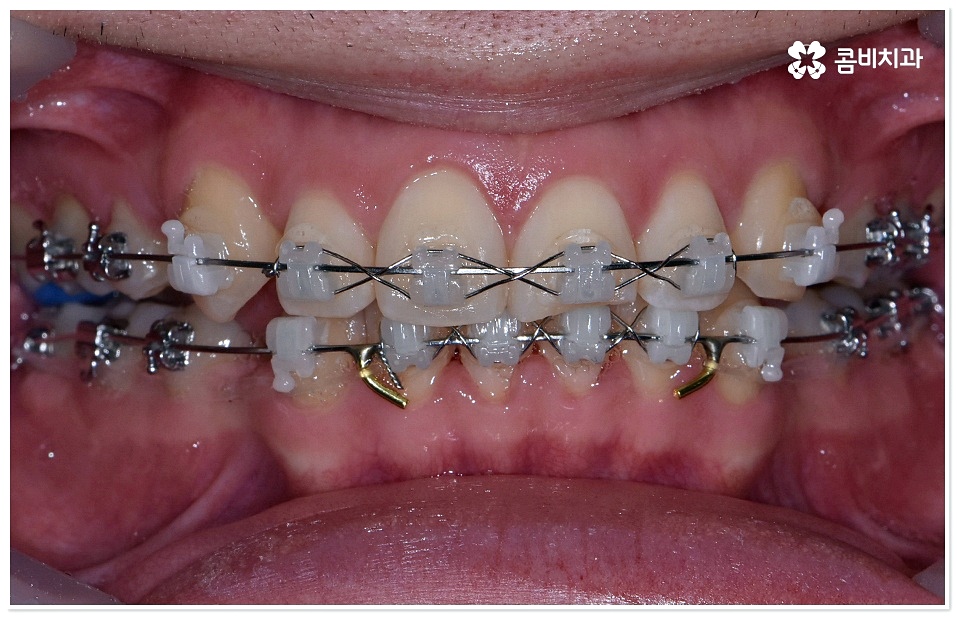 덧니치아교정 고려할 사항들은 관련 이미지 6
