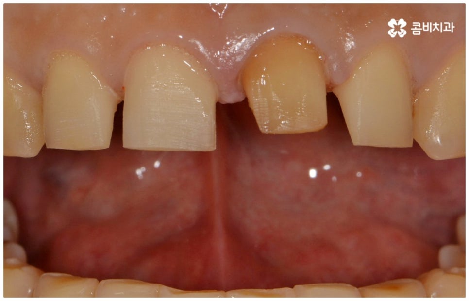 앞니충치치료 어떻게 이뤄지나요 관련 이미지 6