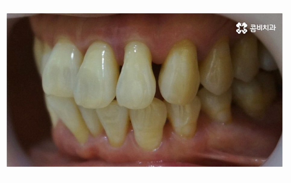 어금니 발치 심각해지기 전에 막으려면 관련 이미지 5