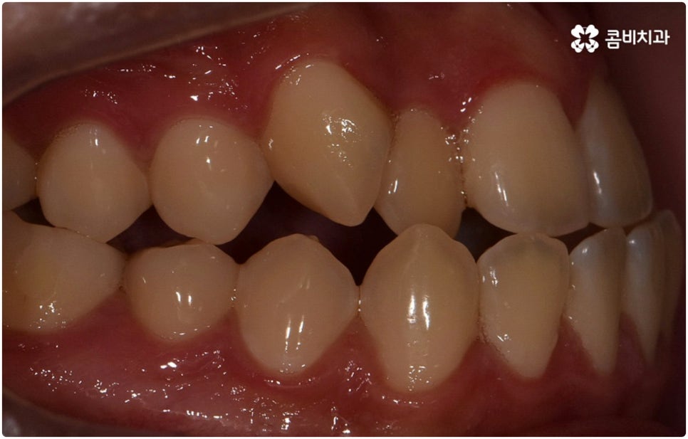 부정교합 3급 고치는 방법은 관련 이미지 4