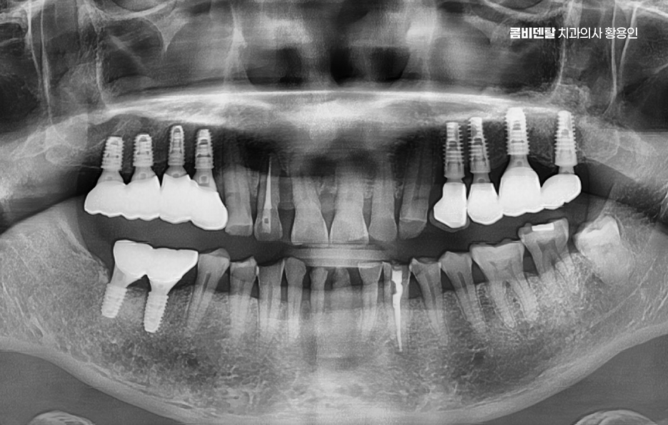 어금니 임플란트 과정 제대로 이해하려면 관련 이미지 12