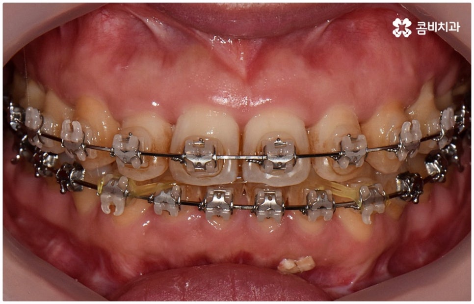 반대교합교정 늦지 않았어요 관련 이미지 12
