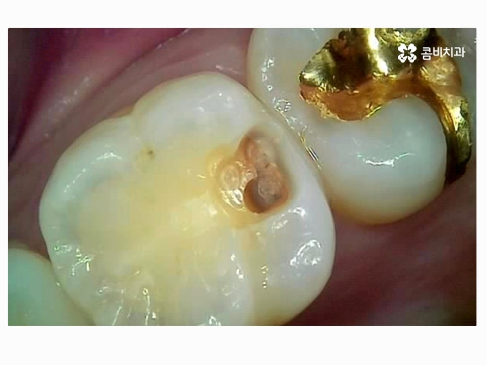 명동치과 누구나 놓치기 쉬운 문제점은! 관련 이미지 4