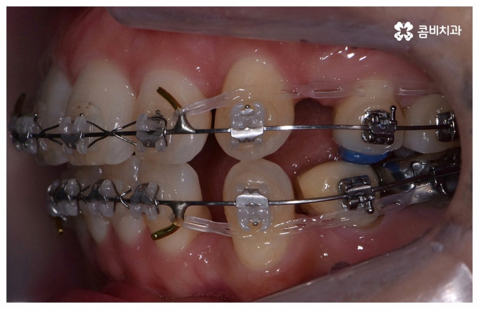 중년치아교정 원한다면 관련 이미지 12