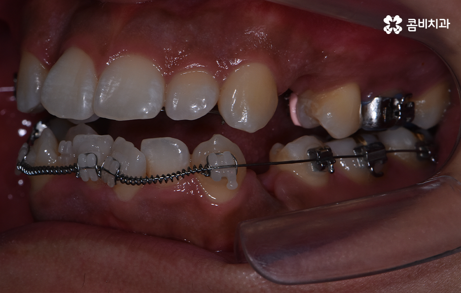 덧니 발치 교정 현명하게 선택하려면 관련 이미지 10