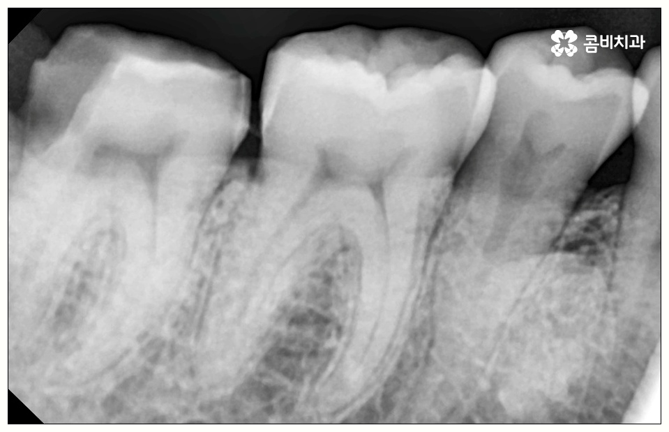 어금니 사이 충치 빠르게 대응해야 관련 이미지 7