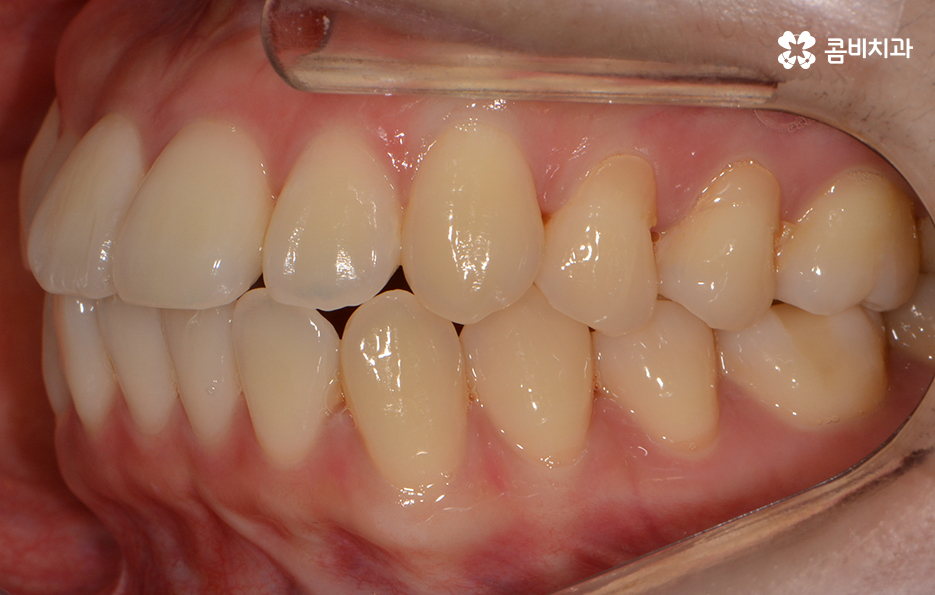 앞니치아교정 자연스러운 결과를 위해 알아둬야 할 점 관련 이미지 4