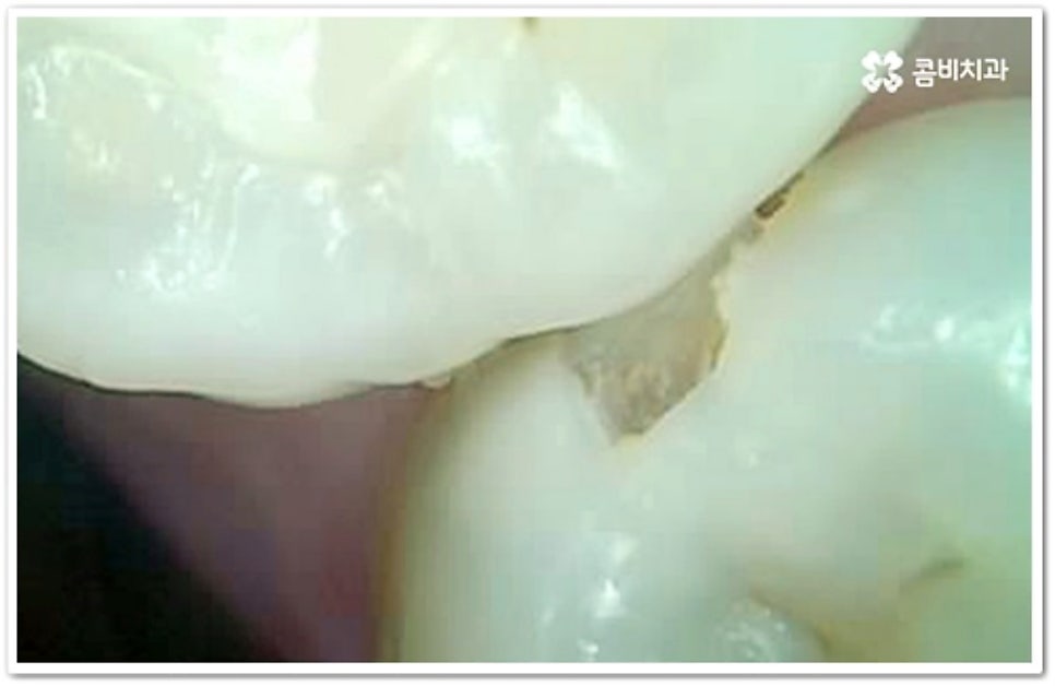 인접면 충치 어떻게 하나요 관련 이미지 4