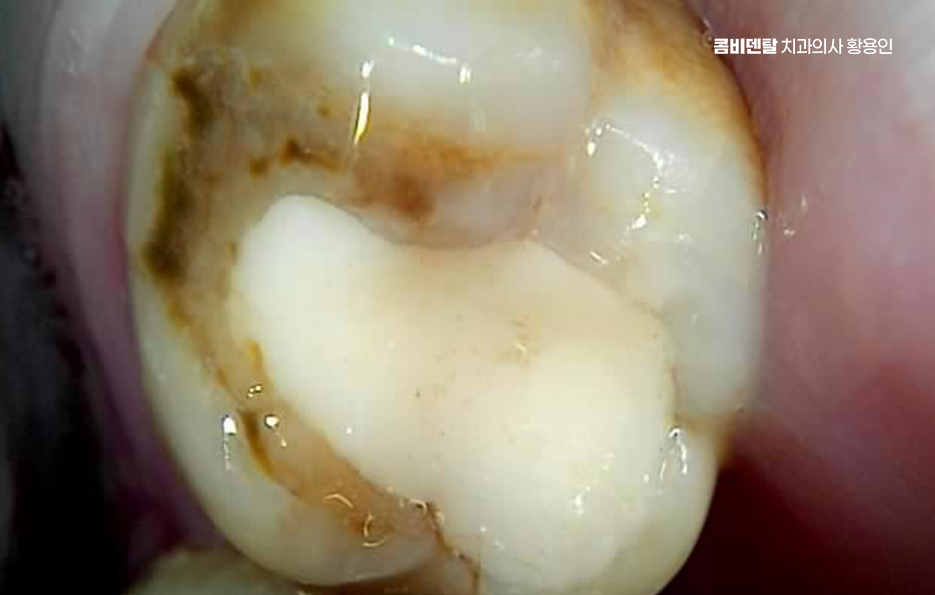 인레이 치료 후 신경치료 이유가 궁금하다면 관련 이미지 11