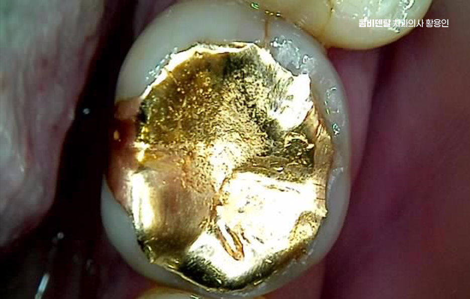 인레이 치료 후 신경치료 이유가 궁금하다면 관련 이미지 10